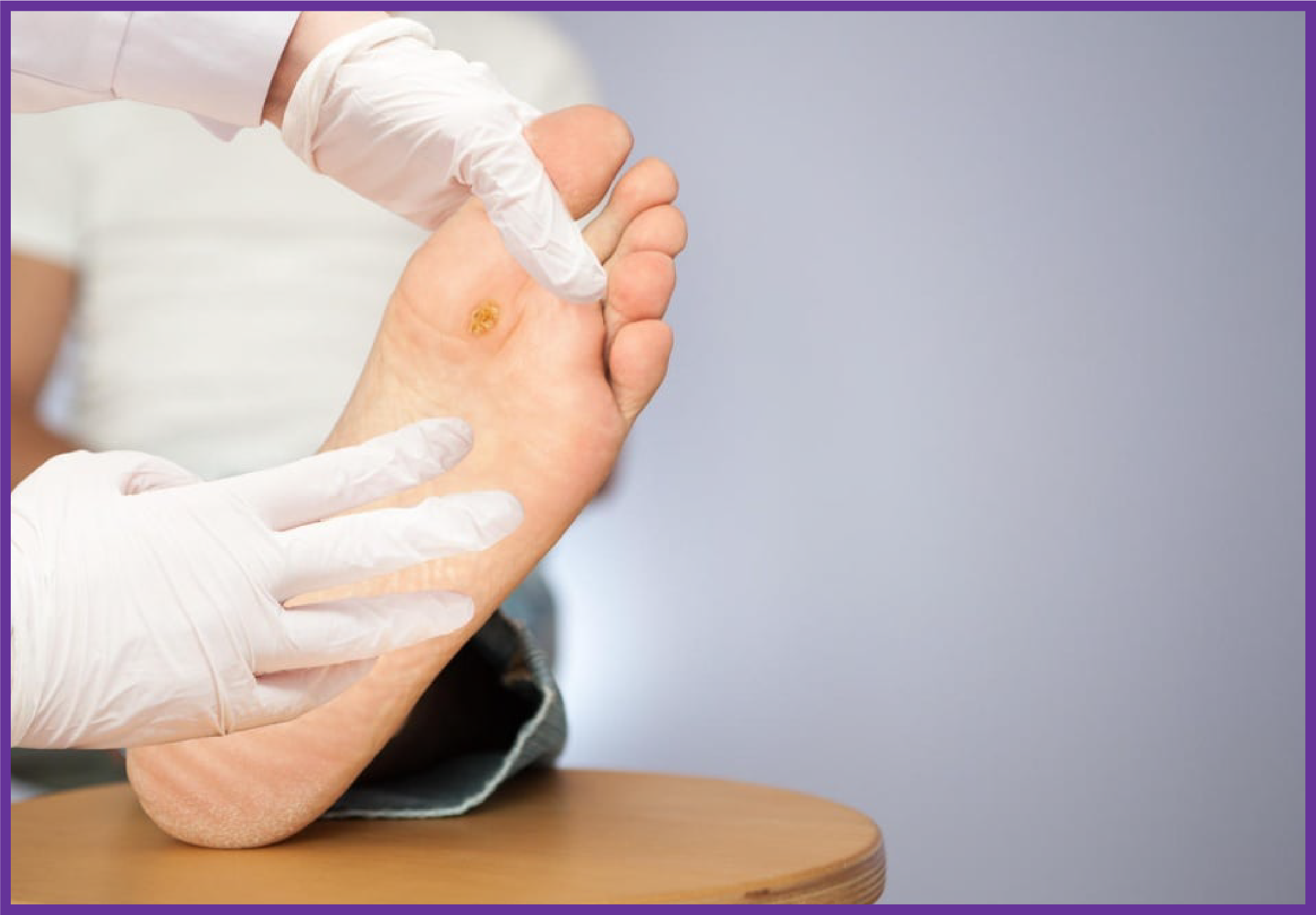 A healthcare professional wearing gloves examining a plantar ulcer on a patient's foot in a clinical setting