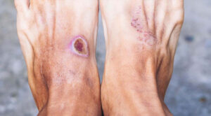 Close-up of diabetic foot ulcers showing open wounds and damaged skin caused by poor circulation and infection.