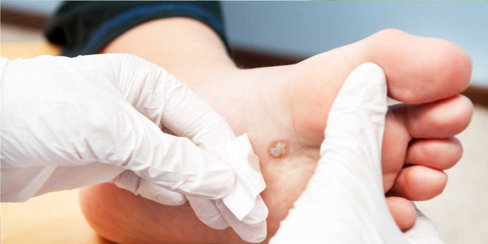 Healthcare professional treating a diabetic foot ulcer by dressing a blister on the foot with sterile gloves and materials. Proper guidelines for ulcer care.