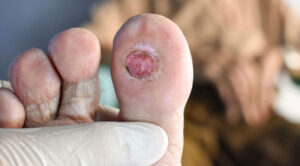 Close-up of a toe with a diabetic ulcer being examined by a healthcare professional wearing gloves.