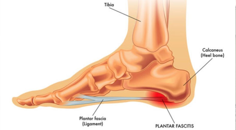 Diagram showing the anatomy of the foot with focus on the plantar fascia and the area affected by plantar fasciitis.