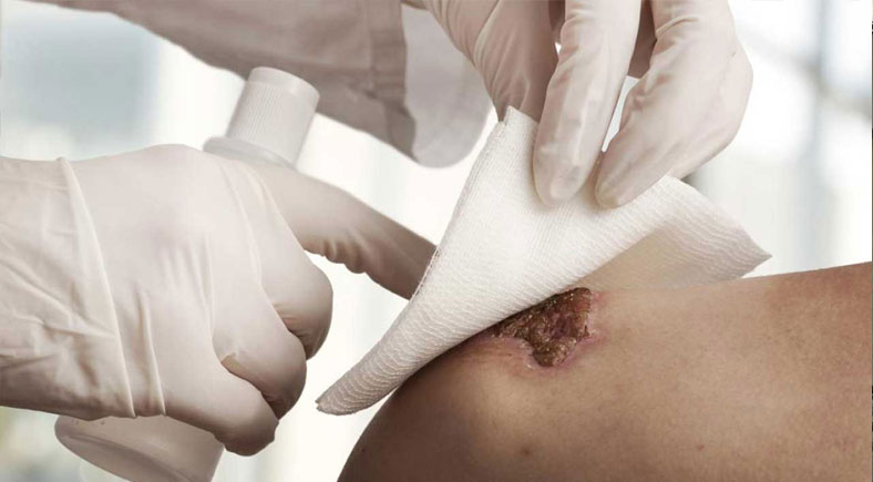 A healthcare professional wearing gloves is cleaning a wound on a person's skin with gauze and antiseptic spray.